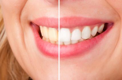 split screen of smile before and after whitening